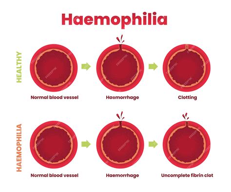 hemofilie wikipedia